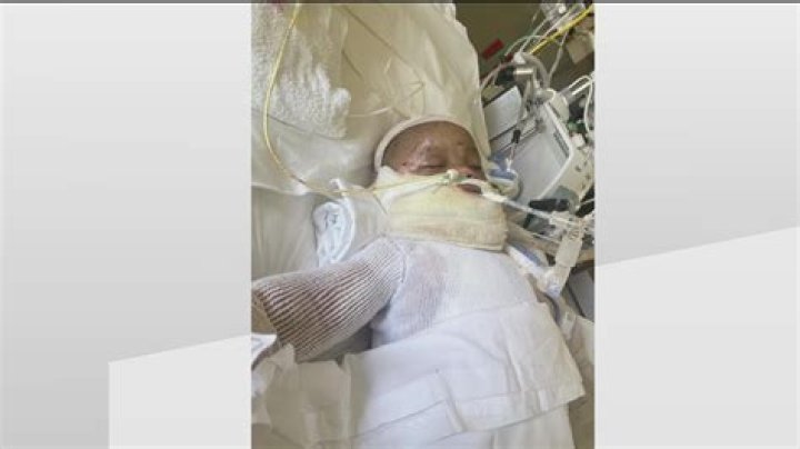 Amahd Black Georgia baby badly burned in freak accident