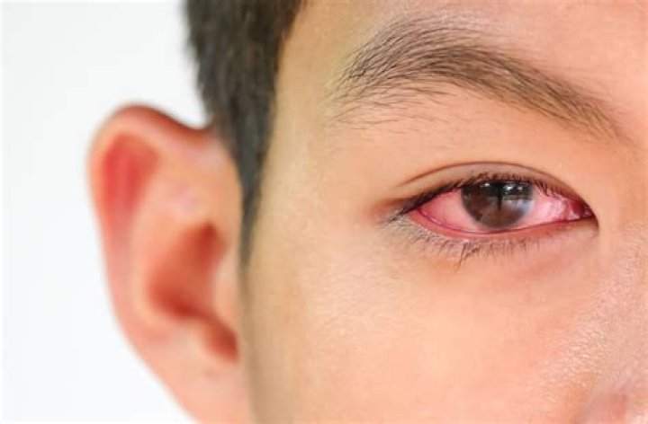 Can Rheumatoid Arthritis Affect Your Eyes?