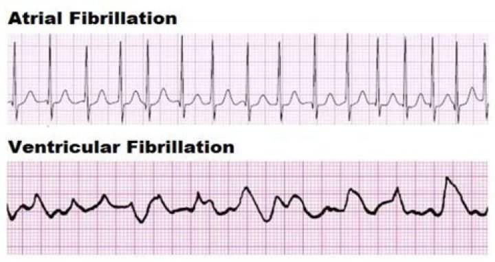 Difference Between Atrial And Ventricular Fibrillation