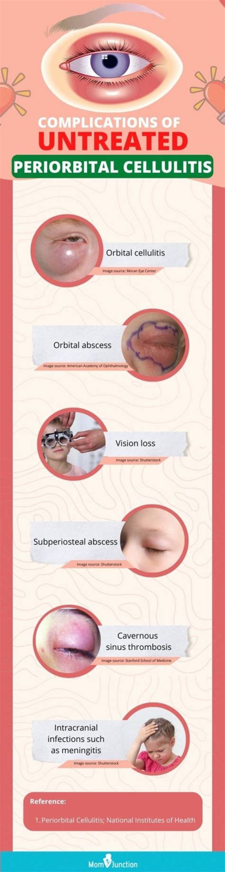 Periorbital Cellulitis - All About Vision