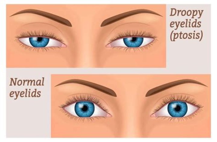 Ptosis: Droopy Eyelids - All About Vision