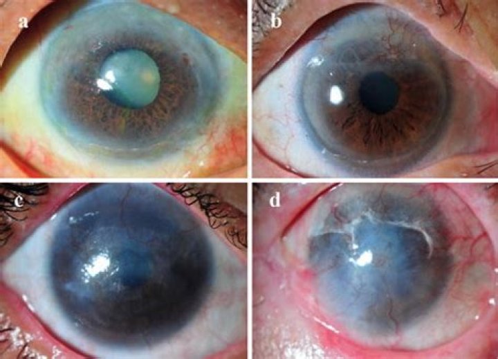 What Is Corneal Neovascularization?