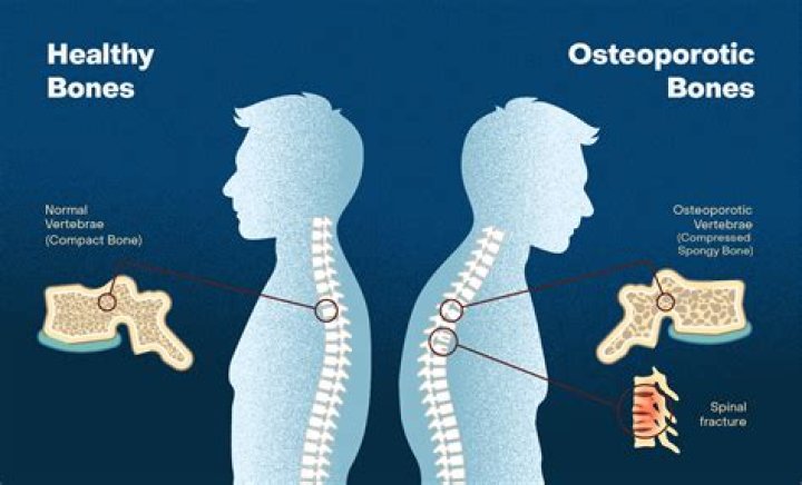 What Is Osteoporosis - Weakening Of The Bones And It's Causes